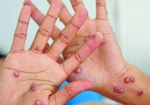 Reportan 161 casos de viruela del mono en La Libertad y Minsa pide a la población con VIH vacunarse